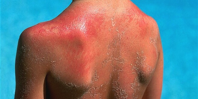 Nước thải công nghiệp là gì? Thành phần và tác hại nếu không xử lý 3 sun burn 1462360402 1
